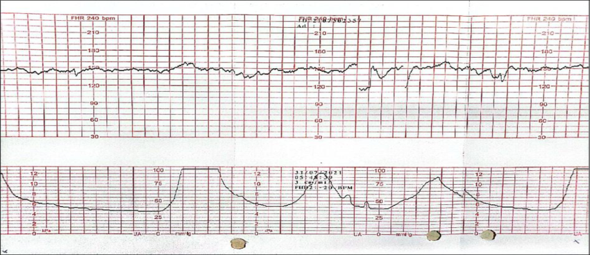 ECT and CTG Papers